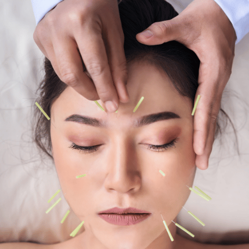 Acupuncture For Sleep Does It Help With Insomnia